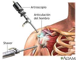 Artroscopia de hombro